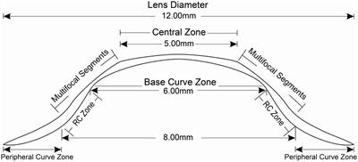 High myopia control is comparable between multifocal rigid gas-permeable lenses and spectacles